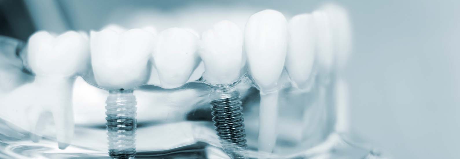 Zahnimplantate bei Parodontitis - Zahnarzt Bregenz